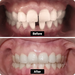 Condición: dientes recogidos