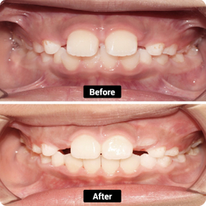Condición: Overbite, Overjet y Dientes espaciados