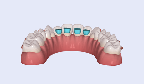 Bite-Ramps-in-Clear-Aligner-Treatment.png